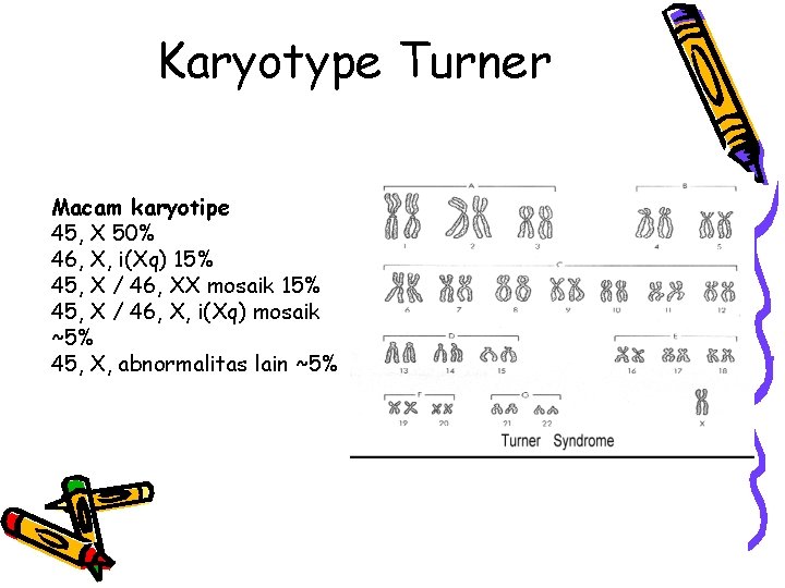 Karyotype Turner Macam karyotipe 45, X 50% 46, X, i(Xq) 15% 45, X /