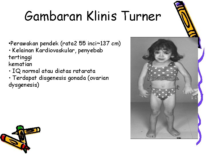 Gambaran Klinis Turner • Perawakan pendek (rata 2 55 inci~137 cm) • Kelainan Kardiovaskular,