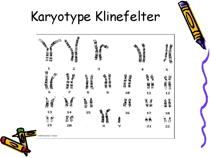 Karyotype Klinefelter 