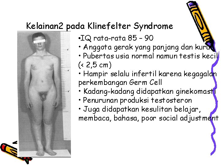 Kelainan 2 pada Klinefelter Syndrome • IQ rata-rata 85 – 90 • Anggota gerak