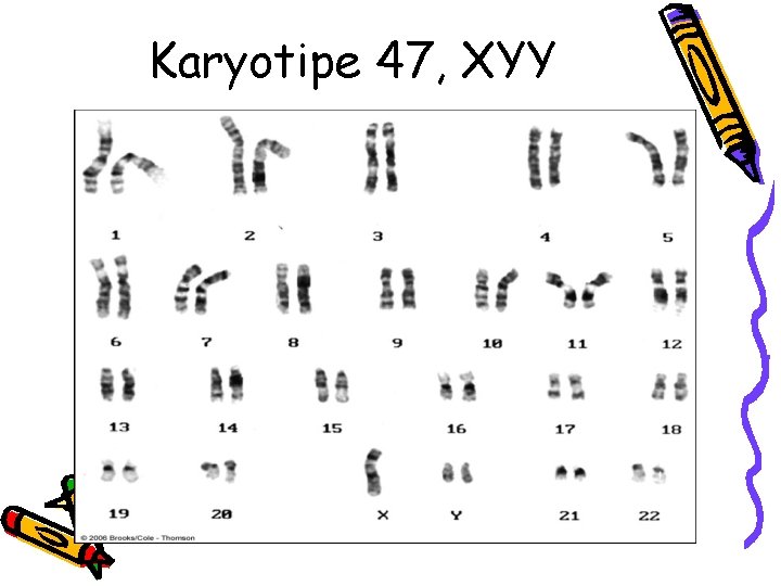 Karyotipe 47, XYY 