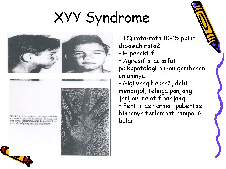 XYY Syndrome • IQ rata-rata 10 -15 point dibawah rata 2 • Hiperaktif •