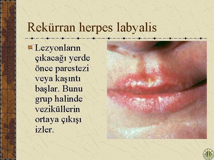 Rekürran herpes labyalis Lezyonların çıkacağı yerde önce parestezi veya kaşıntı başlar. Bunu grup halinde