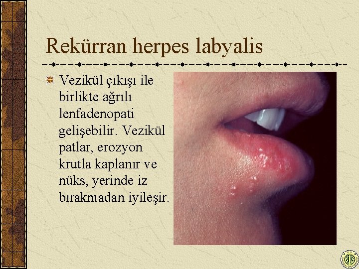 Rekürran herpes labyalis Vezikül çıkışı ile birlikte ağrılı lenfadenopati gelişebilir. Vezikül patlar, erozyon krutla