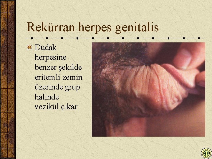 Rekürran herpes genitalis Dudak herpesine benzer şekilde eritemli zemin üzerinde grup halinde vezikül çıkar.