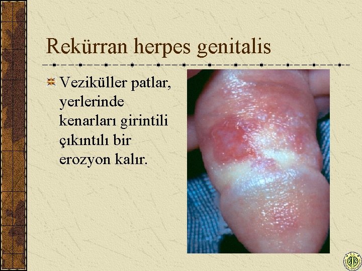 Rekürran herpes genitalis Veziküller patlar, yerlerinde kenarları girintili çıkıntılı bir erozyon kalır. 