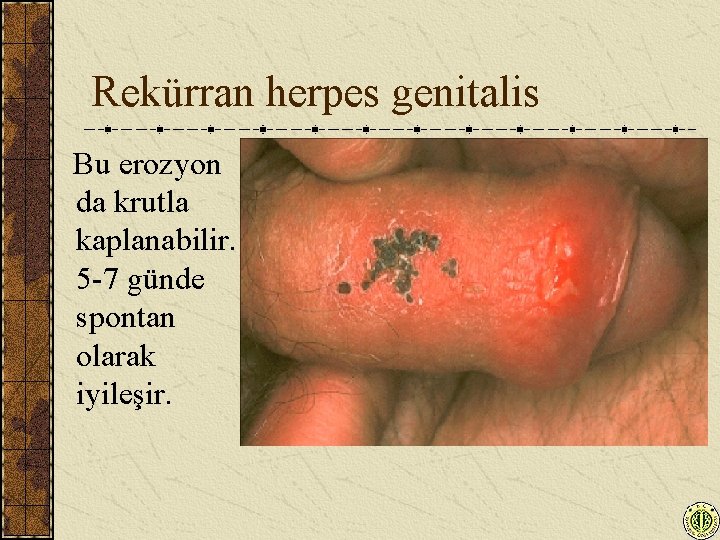 Genitalia herpes 