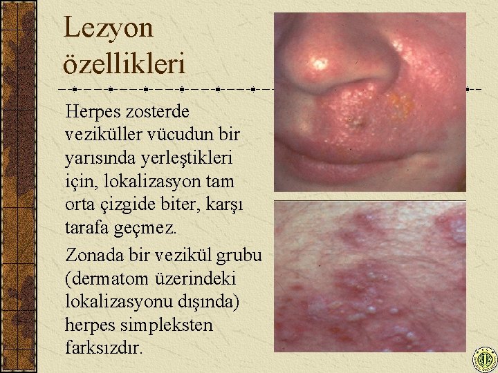 Lezyon özellikleri Herpes zosterde veziküller vücudun bir yarısında yerleştikleri için, lokalizasyon tam orta çizgide