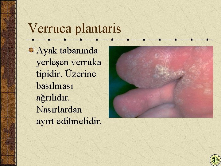 Verruca plantaris Ayak tabanında yerleşen verruka tipidir. Üzerine basılması ağrılıdır. Nasırlardan ayırt edilmelidir. 