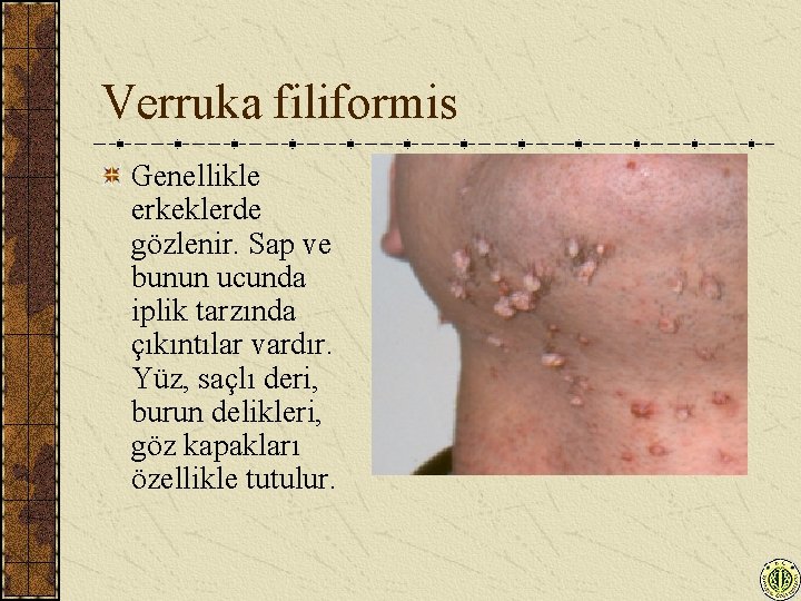 Verruka filiformis Genellikle erkeklerde gözlenir. Sap ve bunun ucunda iplik tarzında çıkıntılar vardır. Yüz,