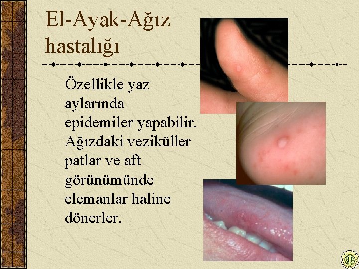 El-Ayak-Ağız hastalığı Özellikle yaz aylarında epidemiler yapabilir. Ağızdaki veziküller patlar ve aft görünümünde elemanlar