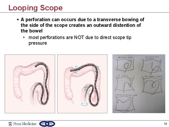 Looping Scope w A perforation can occurs due to a transverse bowing of the