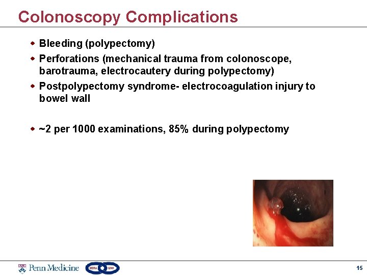 Colonoscopy Complications w Bleeding (polypectomy) w Perforations (mechanical trauma from colonoscope, barotrauma, electrocautery during