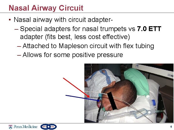 Nasal Airway Circuit • Nasal airway with circuit adapter– Special adapters for nasal trumpets