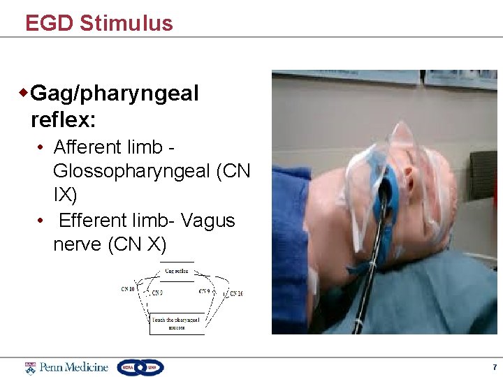 EGD Stimulus w. Gag/pharyngeal reflex: • Afferent limb Glossopharyngeal (CN IX) • Efferent limb-