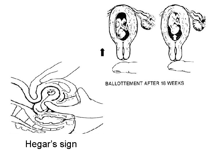 Hegar’s sign Hegar’s sign