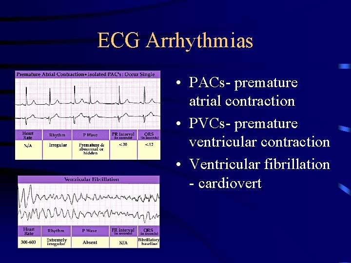 ECG Arrhythmias • PACs- premature atrial contraction • PVCs- premature ventricular contraction • Ventricular