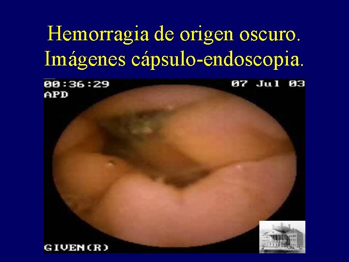 Hemorragia de origen oscuro. Imágenes cápsulo-endoscopia. Hemorragia de origen oscuro. Imágenes cápsulo-endoscopia.