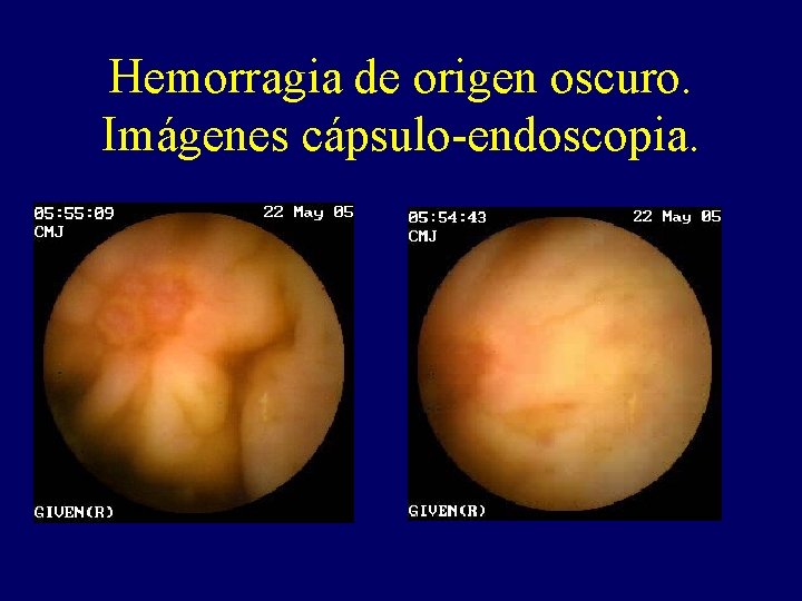 Hemorragia de origen oscuro. Imágenes cápsulo-endoscopia. Hemorragia de origen oscuro. Imágenes cápsulo-endoscopia.