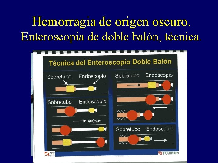 Hemorragia de origen oscuro. Enteroscopia de doble balón, técnica. Hemorragia de origen oscuro. Enteroscopia de doble balón, técnica.