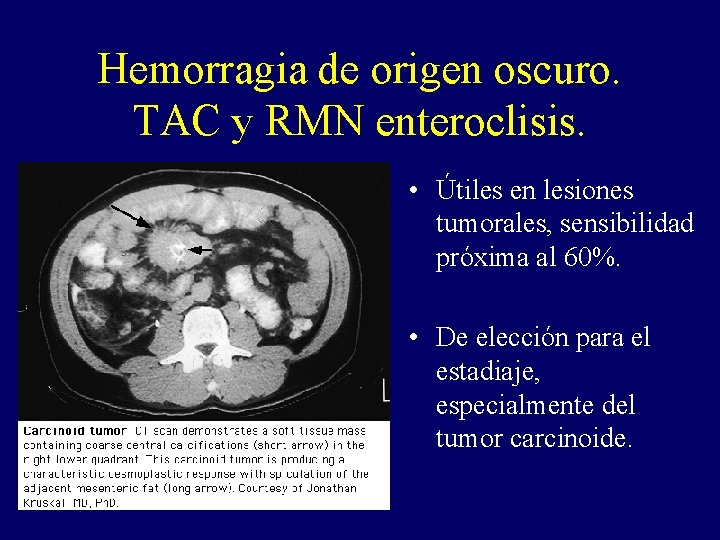 Hemorragia de origen oscuro. TAC y RMN enteroclisis. • Útiles en lesiones tumorales, sensibilidad Hemorragia de origen oscuro. TAC y RMN enteroclisis. • Útiles en lesiones tumorales, sensibilidad