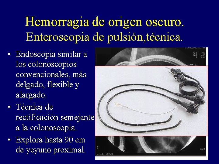 Hemorragia de origen oscuro. Enteroscopia de pulsión, técnica. • Endoscopia similar a los colonoscopios Hemorragia de origen oscuro. Enteroscopia de pulsión, técnica. • Endoscopia similar a los colonoscopios