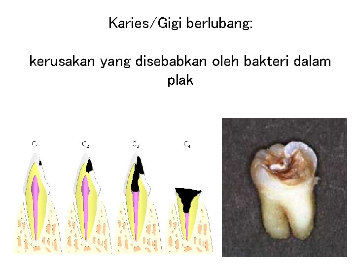 Karies/Gigi berlubang: kerusakan yang disebabkan oleh bakteri dalam plak 