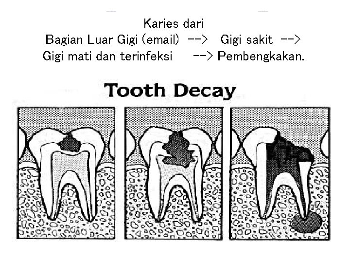 Karies dari Bagian Luar Gigi (email) --> Gigi sakit --> Gigi mati dan terinfeksi