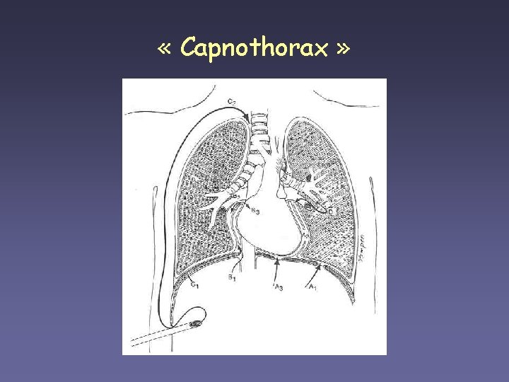  « Capnothorax » 