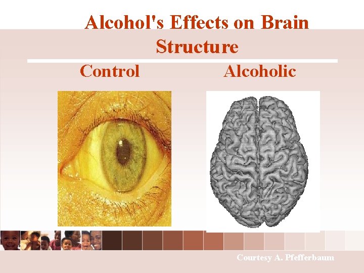 Alcohol's Effects on Brain Structure Control Alcoholic Courtesy A. Pfefferbaum Alcohol's Effects on Brain Structure Control Alcoholic Courtesy A. Pfefferbaum