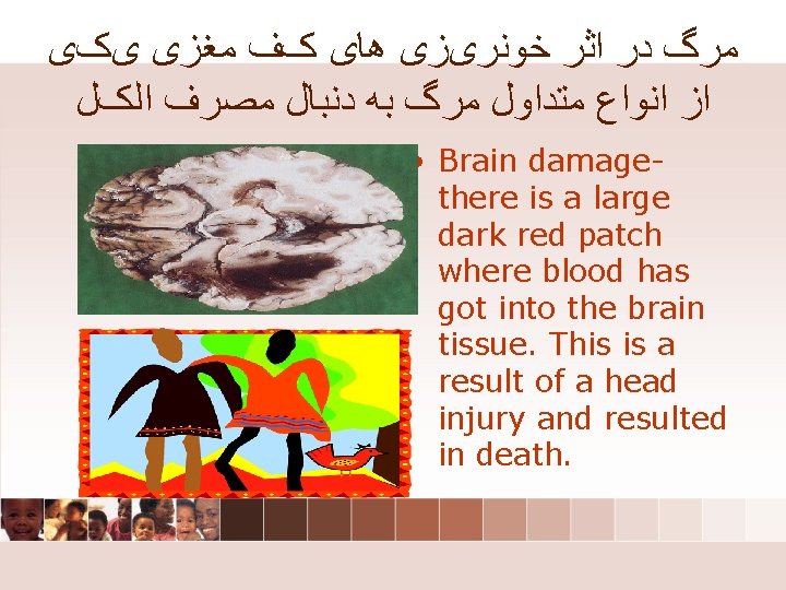 ﻣﺮگ ﺩﺭ ﺍﺛﺮ ﺧﻮﻧﺮیﺰی ﻫﺎی کﻒ ﻣﻐﺰی یکی ﺍﺯ ﺍﻧﻮﺍﻉ ﻣﺘﺪﺍﻭﻝ ﻣﺮگ ﺑﻪ ﻣﺮگ ﺩﺭ ﺍﺛﺮ ﺧﻮﻧﺮیﺰی ﻫﺎی کﻒ ﻣﻐﺰی یکی ﺍﺯ ﺍﻧﻮﺍﻉ ﻣﺘﺪﺍﻭﻝ ﻣﺮگ ﺑﻪ