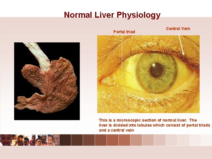 Normal Liver Physiology Portal triad The liver is the largest of the abdominal organs Normal Liver Physiology Portal triad The liver is the largest of the abdominal organs