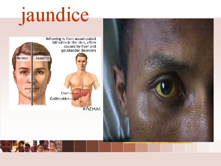 jaundice jaundice