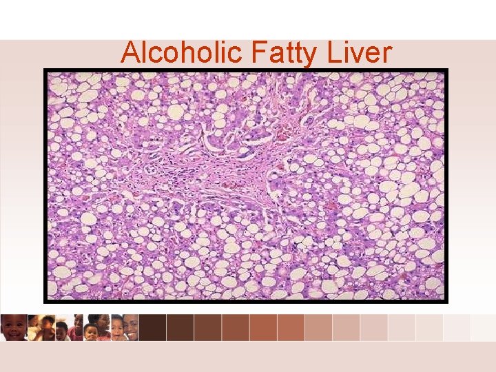 Alcoholic Fatty Liver Alcoholic Fatty Liver