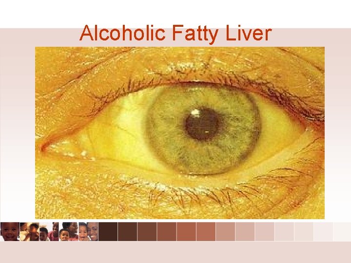 Alcoholic Fatty Liver Alcoholic Fatty Liver