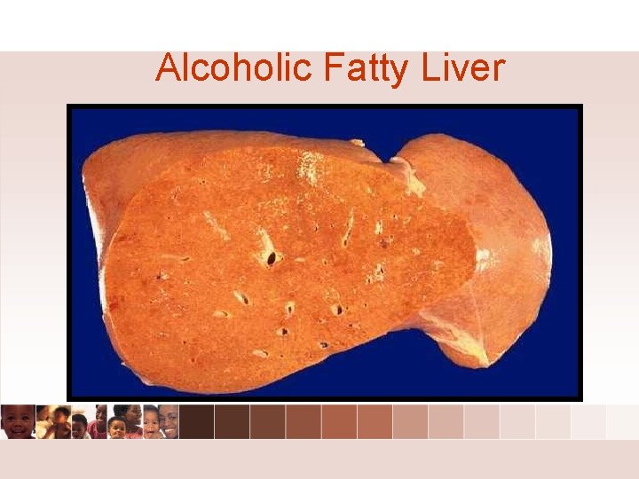 Alcoholic Fatty Liver Alcoholic Fatty Liver