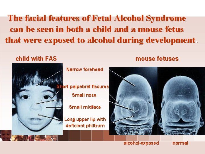 The facial features of Fetal Alcohol Syndrome can be seen in both a child The facial features of Fetal Alcohol Syndrome can be seen in both a child