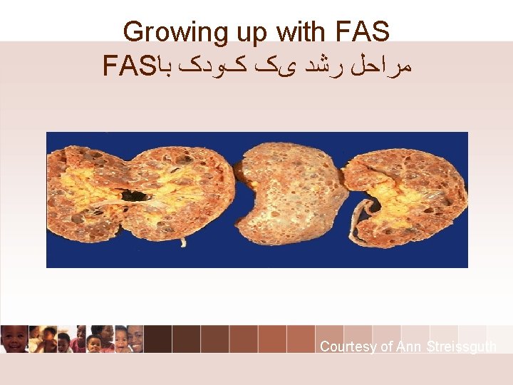 Growing up with FAS ﻣﺮﺍﺣﻞ ﺭﺷﺪ یک کﻮﺩک ﺑﺎ Courtesy of Ann Streissguth Growing up with FAS ﻣﺮﺍﺣﻞ ﺭﺷﺪ یک کﻮﺩک ﺑﺎ Courtesy of Ann Streissguth