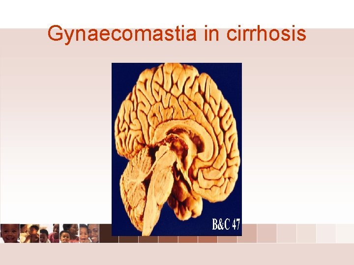 Gynaecomastia in cirrhosis Gynaecomastia in cirrhosis