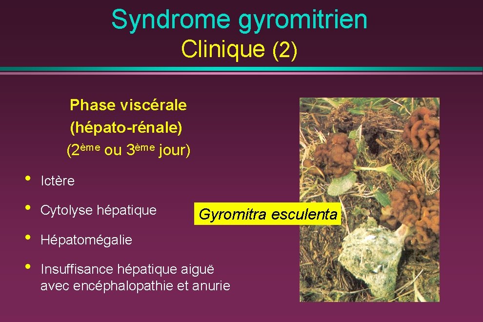 Syndrome gyromitrien Clinique (2) Phase viscérale (hépato-rénale) (2ème ou 3ème jour) • • Ictère