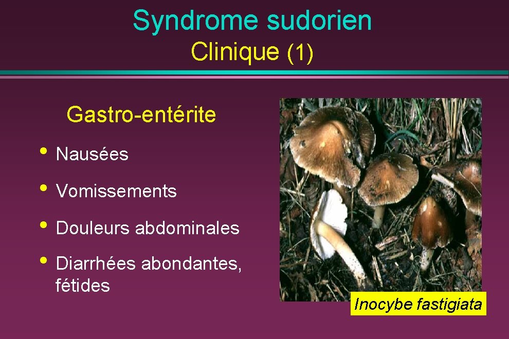 Syndrome sudorien Clinique (1) Gastro-entérite • Nausées • Vomissements • Douleurs abdominales • Diarrhées
