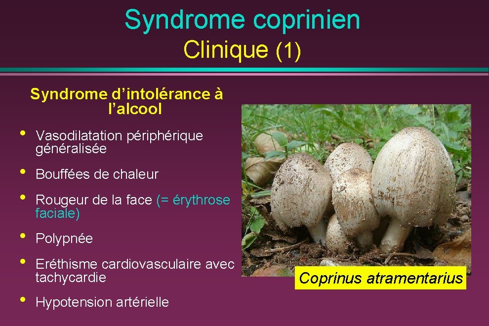 Syndrome coprinien Clinique (1) Syndrome d’intolérance à l’alcool • Vasodilatation périphérique généralisée • •