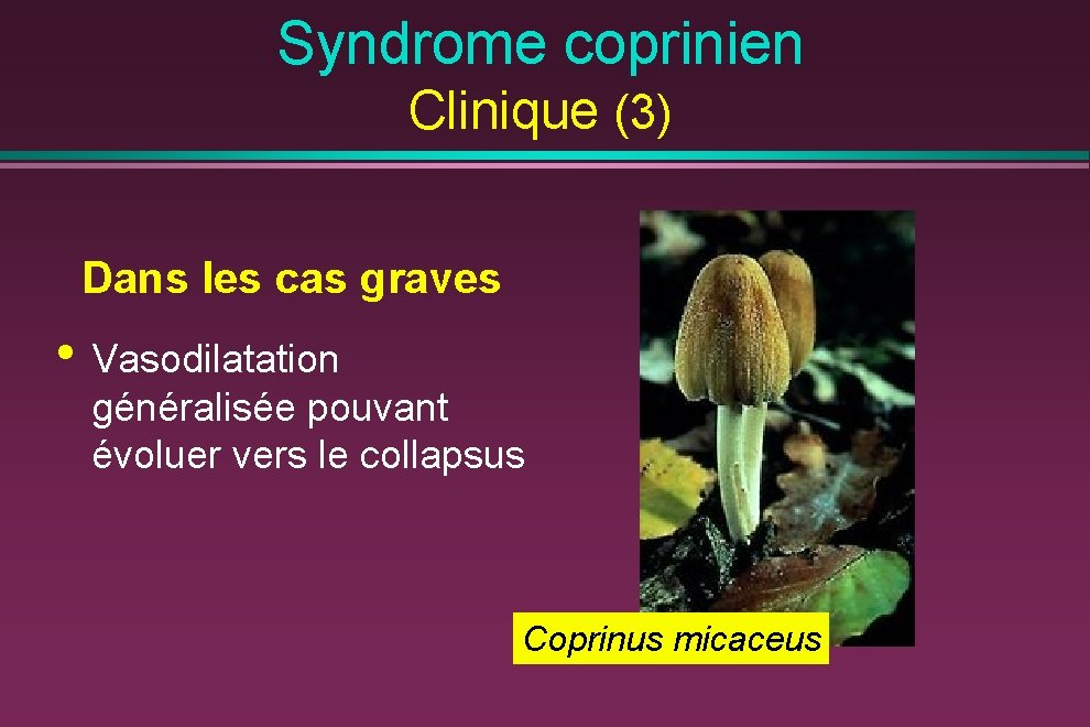 Syndrome coprinien Clinique (3) Dans les cas graves • Vasodilatation généralisée pouvant évoluer vers