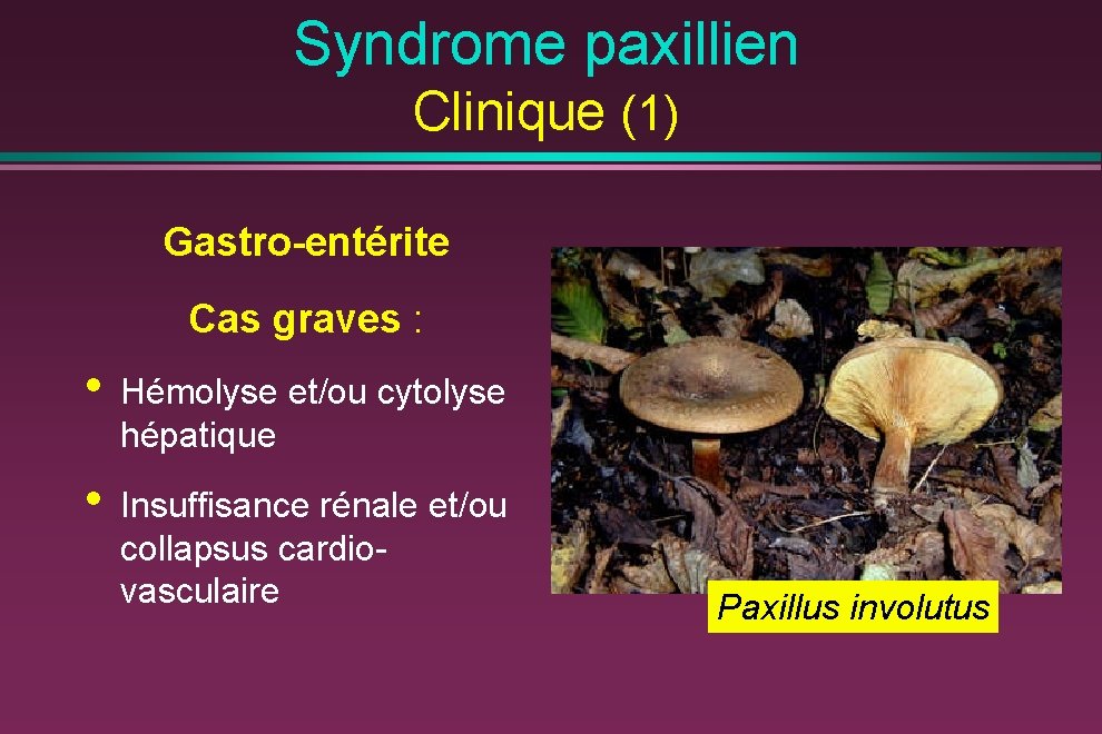 Syndrome paxillien Clinique (1) Gastro-entérite Cas graves : • Hémolyse et/ou cytolyse hépatique •