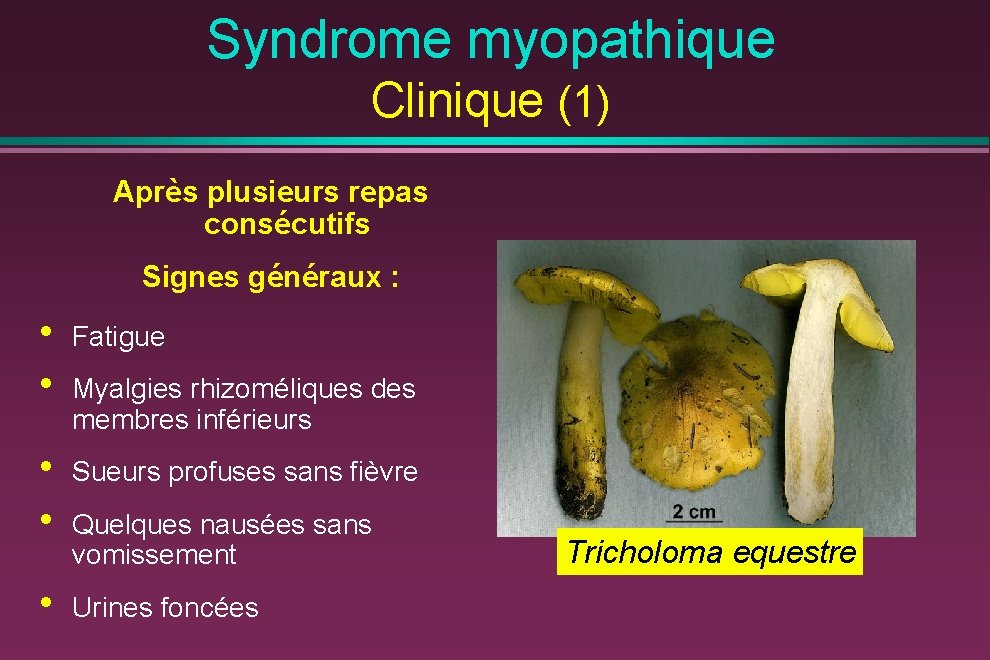 Syndrome myopathique Clinique (1) Après plusieurs repas consécutifs Signes généraux : • • Fatigue