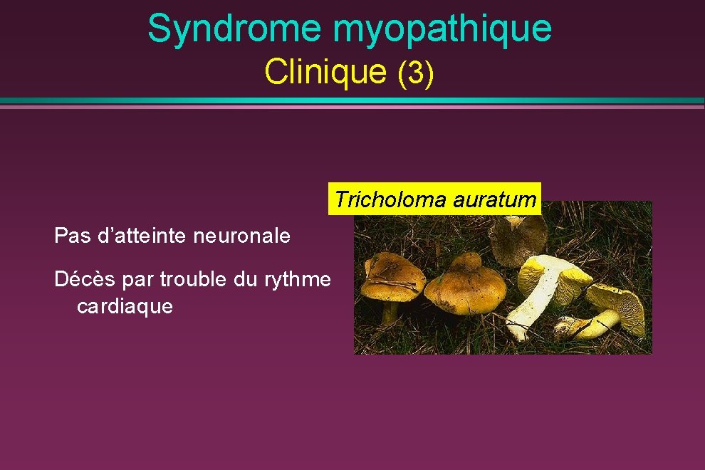 Syndrome myopathique Clinique (3) Tricholoma auratum Pas d’atteinte neuronale Décès par trouble du rythme
