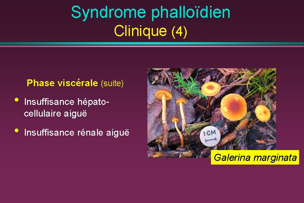 Syndrome phalloïdien Clinique (4) Phase viscérale (suite) • Insuffisance hépatocellulaire aiguë • Insuffisance rénale