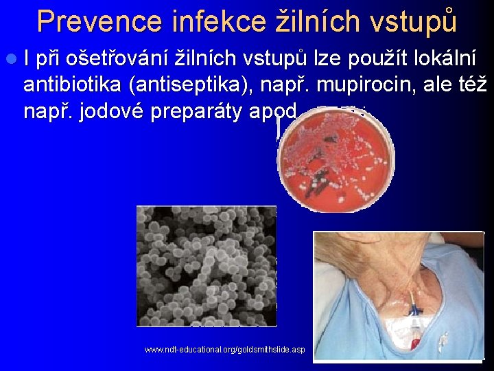 Prevence infekce žilních vstupů l I při ošetřování žilních vstupů lze použít lokální antibiotika