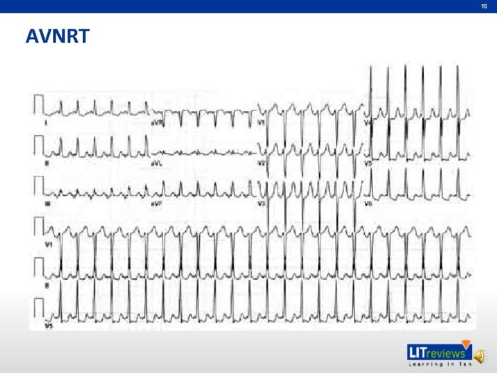 10 AVNRT 