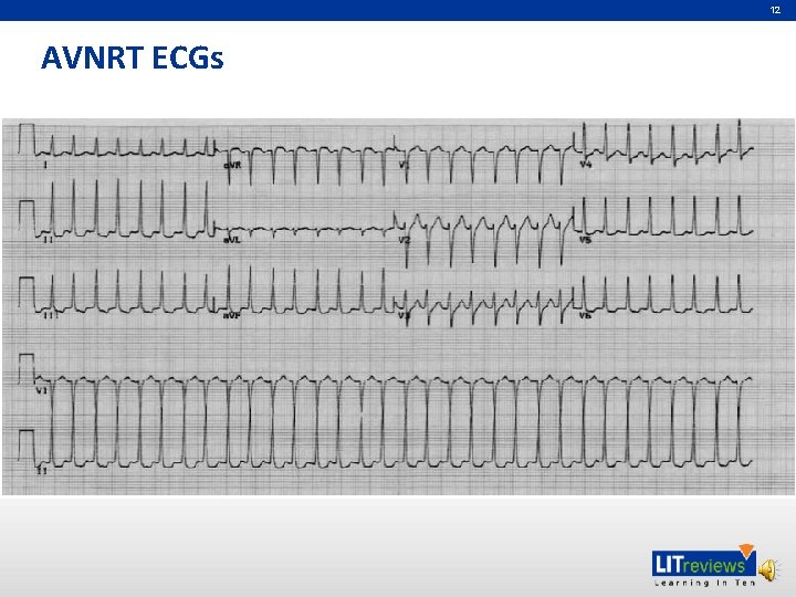 12 AVNRT ECGs 